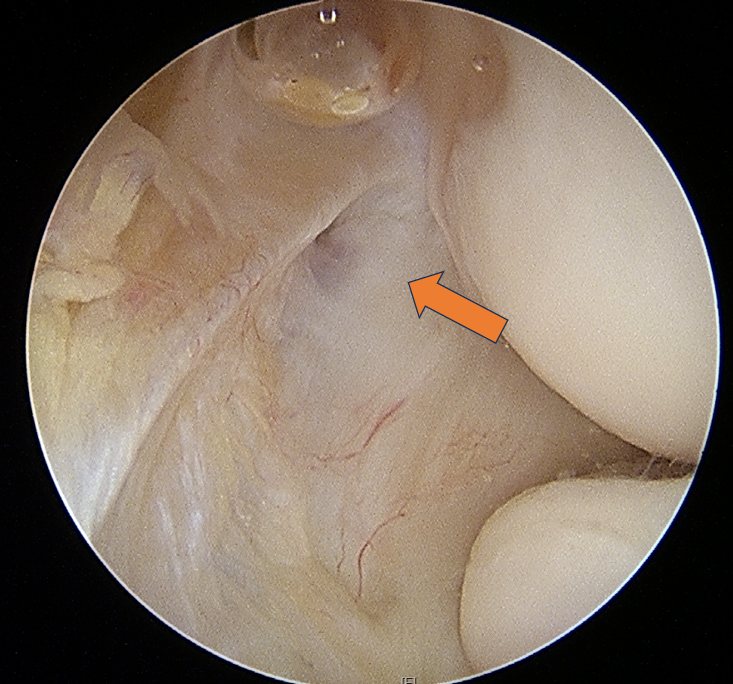 Tennis elbow arthroscopy