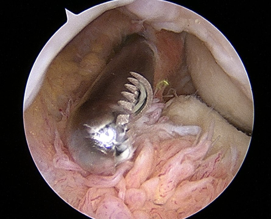 Elbow arthritis surgery