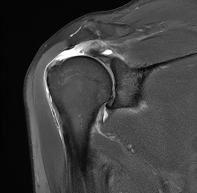 Rotator Cuff Tear MRI