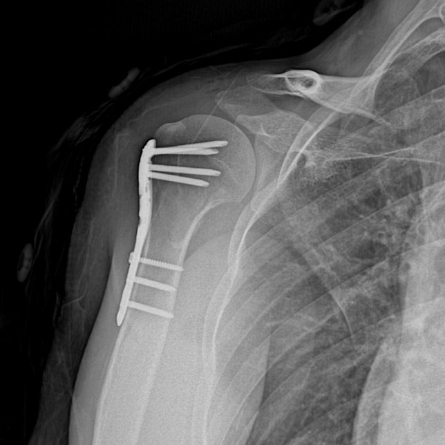 Shoulder fracture surgery X-ray