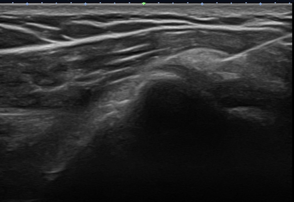 Calcification Barbotage