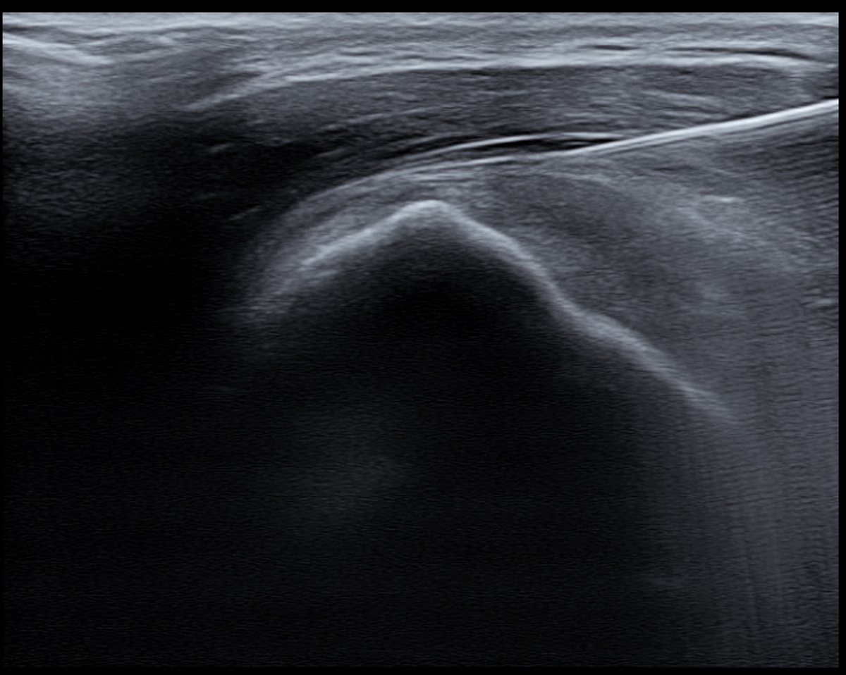 Ultrasound-Guided Injection
