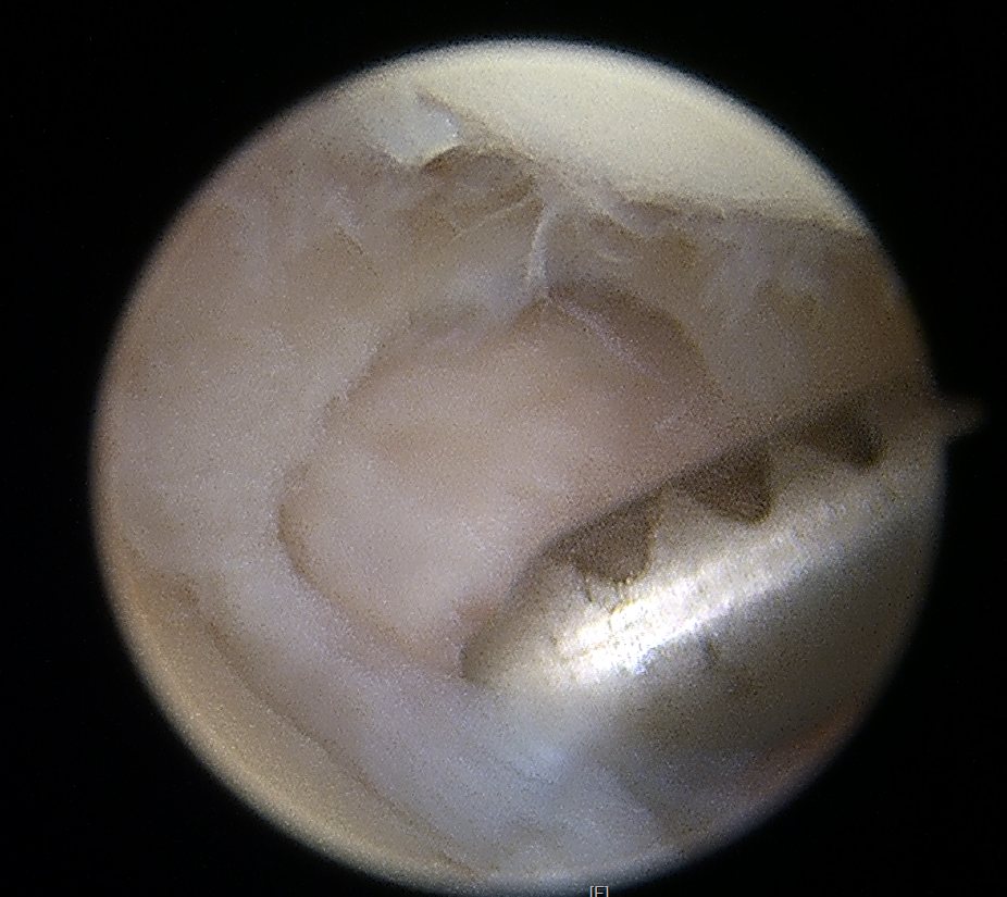 TFCC tear arthroscopy