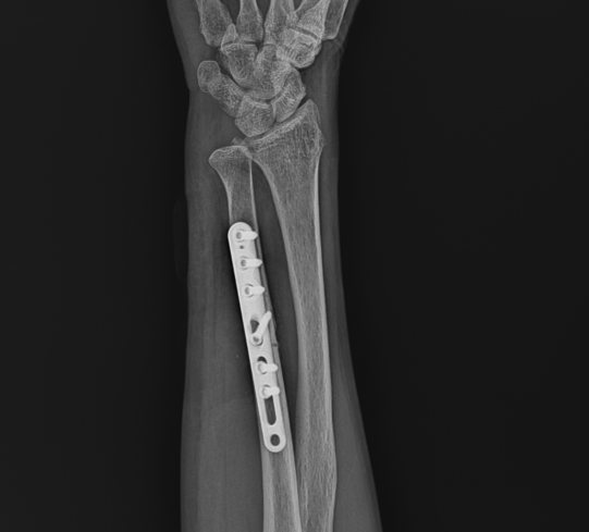 Ulnar shortening osteotomy X-ray
